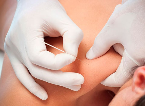 puncion seca elche fisioterapia domicilio